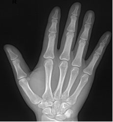 手足短骨解剖及常见疾病的影像学表现