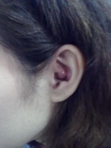 这两天耳朵中间红肿了,还有点痛,这是怎么回事啊 