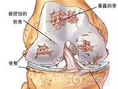 未分化结缔组织病能治好吗 