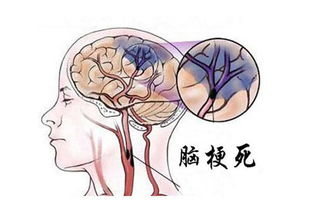 手脚 出现4种症状,脑梗来了,不想常年吃药,少做这4件事 