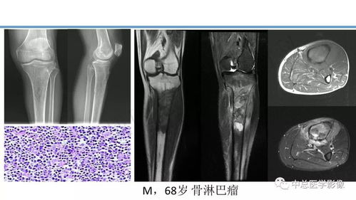 骨肿瘤第4版WHO病理分类浅析与影像诊断