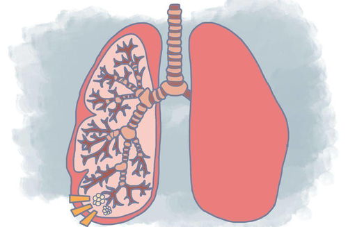 肺病的种类 常见肺病种类有哪些