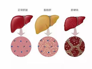 脂肪肝的常見病因：四種原因最易引發(fā)脂肪肝