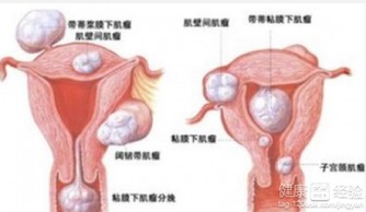 治疗子宫肌瘤选择哪种方法