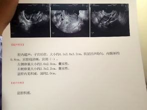 谁能帮我解释一下这个B超是什么意思 谢谢 