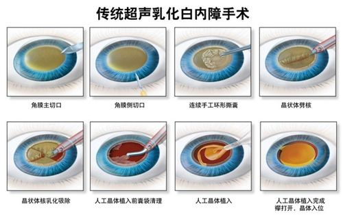 眼睛晶体医保报销吗 晶体置换手术能不能报医保 