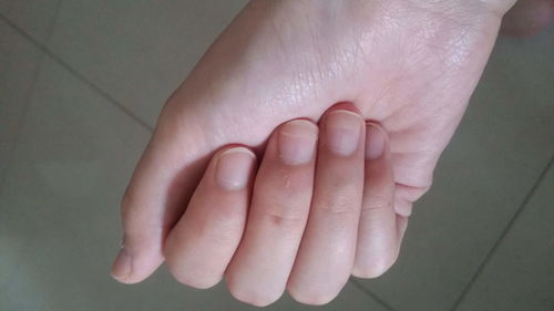 指甲竖纹月牙少是什么原因