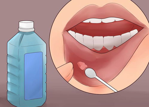 口腔溃疡是不是缺乏白蛋白,口腔溃疡缺少什么