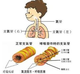 儿童过敏性哮喘