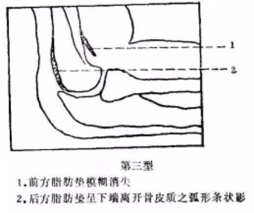 X 线未见异常的儿童肱骨远端骨折,还有什么判别方法