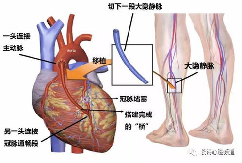 一文读懂冠心病 心脏搭桥