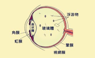 实施飞蚊症手术多少钱 