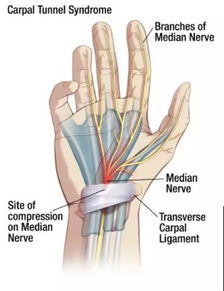 掌长肌缺失和腕管综合征有关联吗
