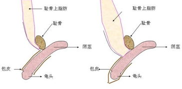 造成阴茎短小的病因有哪些 杭州新城医院