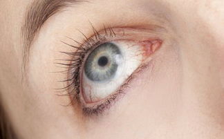 沙眼的危害知多少 严重者可致失明