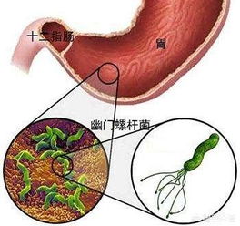 幽门螺杆菌14【++】是什么意思