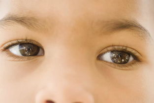 有一种眼病,严重时甚至会致盲,它就是葡萄膜炎 治疗 