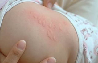 婴儿常见皮肤病 婴幼儿常见的皮肤病有哪些