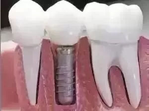为什么好牙医不建议种植牙