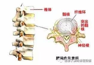 腰椎间盘突出症 我该怎么办 