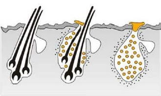 该怎么拯救受损的毛囊,阻止脱发呢