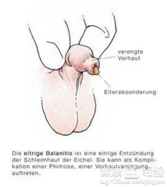 包皮溃烂是怎么回事