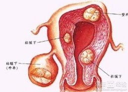 子宫肌瘤可以分为哪些类型