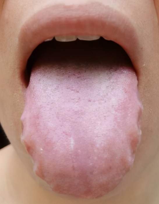 舌体胖大，服用健脾中药，效果反而不好，为什么呢