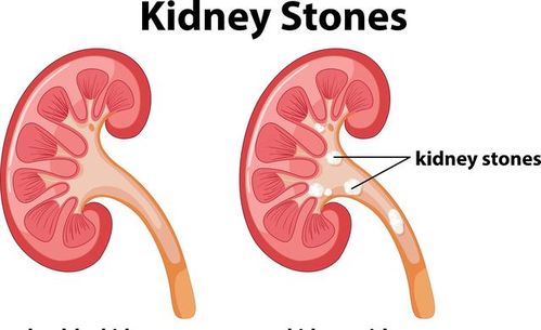 导致肾结石的原因主要有哪些？怎样才能保证不复发？