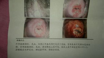 宫颈糜烂2度手术费加治疗费等等 全部下来多钱 是全部 如果最好是做过的知道的告诉我 是全部 