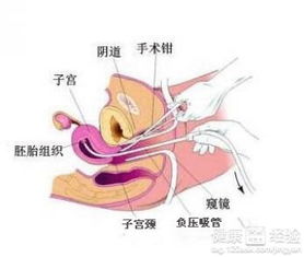 怀孕多少天适合人流(怀孕多少天适合做人流最好)