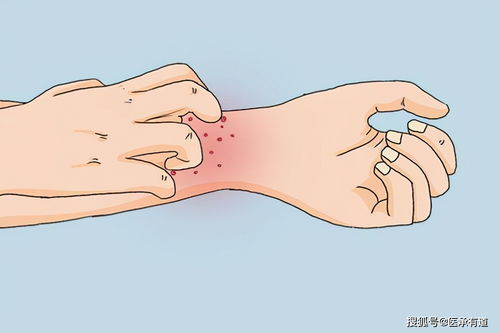 治疗 蛇盘腰 民间中医绝技