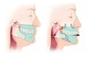 柏德口腔详细讲解 正畸正颌联合治疗的意义