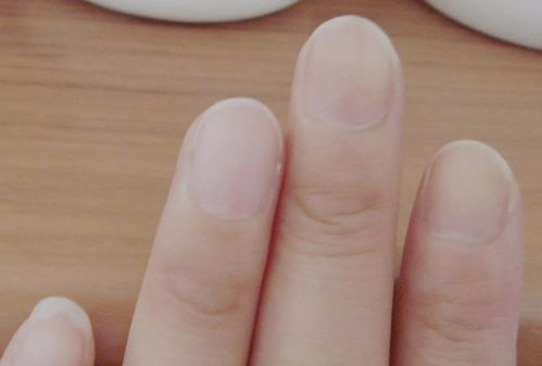 手指甲上的白色月牙是怎么回事