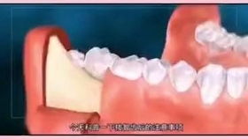 深圳拔智齿后大牙发生疼痛是什么原因呢