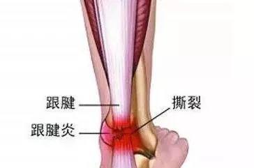 易建联跟腱断裂 跟腱断裂的后果有多严重