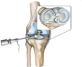 关节镜是如何治疗膝关节炎的