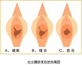 处女膜修复 