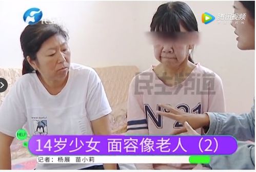 罕见 14岁少女得怪病,面容衰老如7旬老人 父亲的话令人泪崩