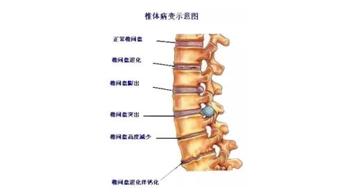 腰椎滑脱怎样治疗和注意什么