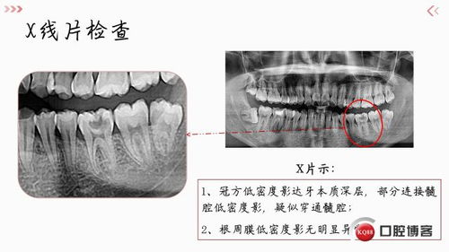 直接盖髓术后树脂直接修复