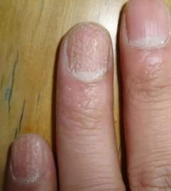 手指甲有月牙和没月牙的区别