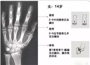 多数家长并不明白孩子长不高,为什么要测骨龄