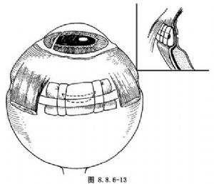 鞏膜環扎術簡介，鞏膜外加壓手術器械