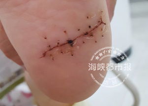 小心 福州牡丹游泳馆 8岁女童去游泳,脚竟被这东西划破缝20多针