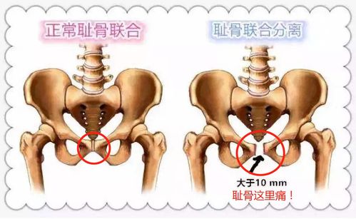 有种 孕晚期噩梦 叫耻骨痛,痛到怀疑人生,这四类孕妈容易中招