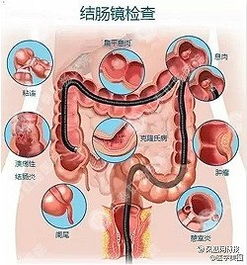 福州肠镜哪里做不错