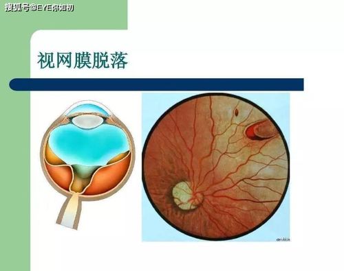 近视并发的这5种情况不及时防控,严重的可致盲