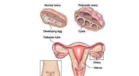 备孕期查到多囊卵巢综合征怎么办