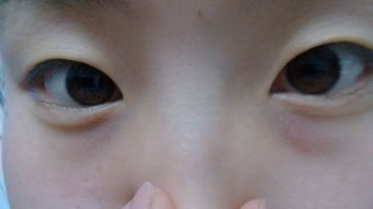 两只眼睛的内侧下眼睑外面很多白点不痛不痒的,不是脂肪粒,不是很明显 
